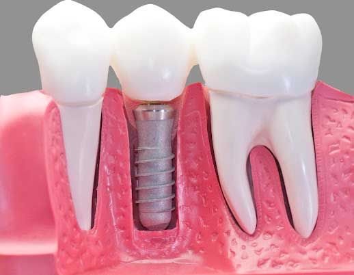 Read more about the article Dental Implants FAQs